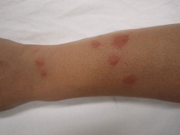 examples of roach bites on humans 2