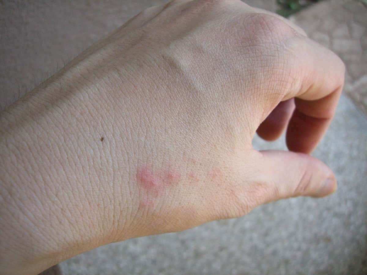 bed bug bites