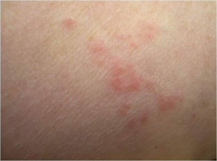 bed bug bites