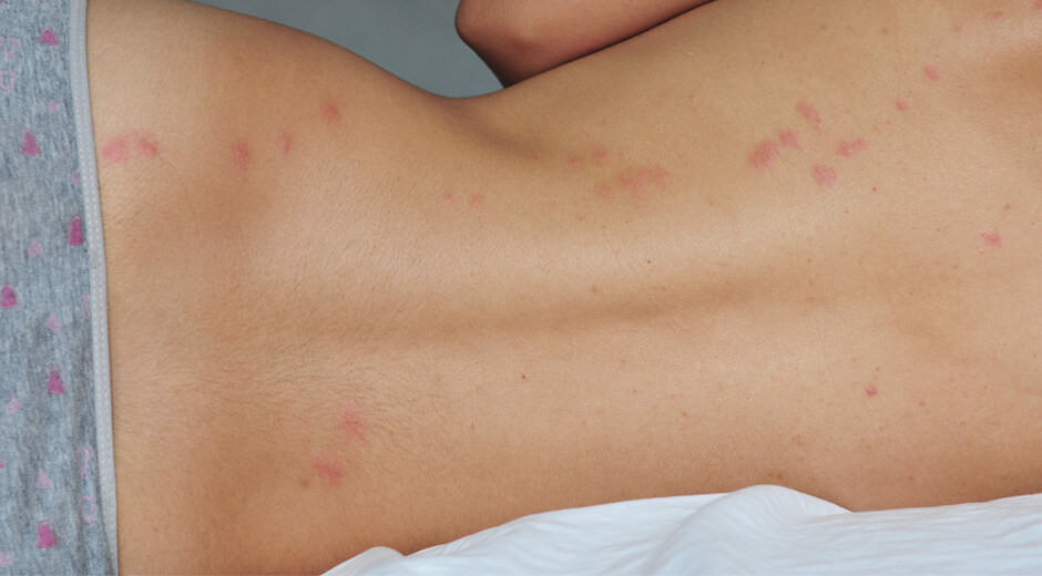 bed bug bites on human body