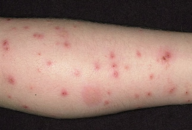 photo of flea bites on leg