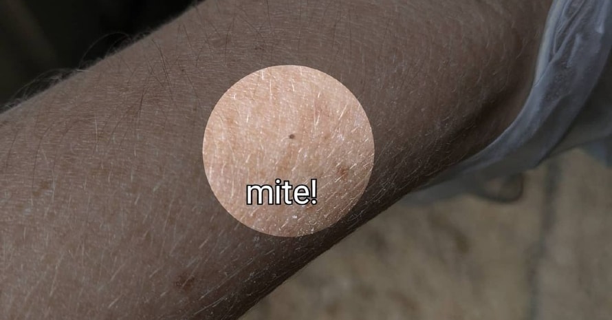 mite on hand